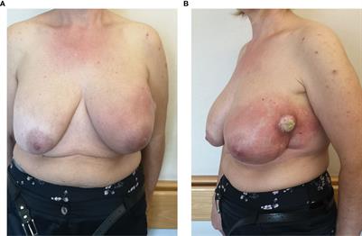 Reverse strategy to locally advanced breast implant-associated anaplastic large cell lymphoma: A case report
